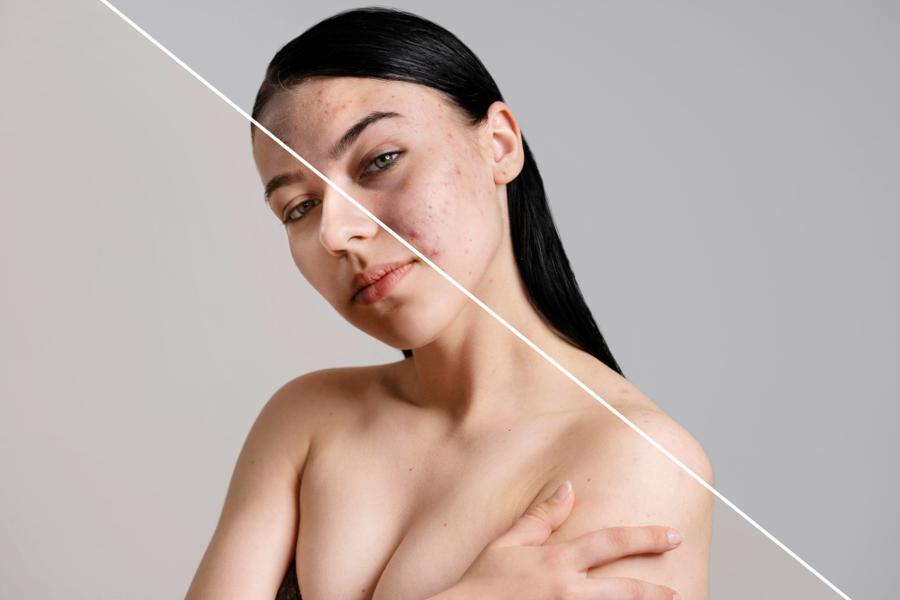 Acne, Acne Scar Treatment