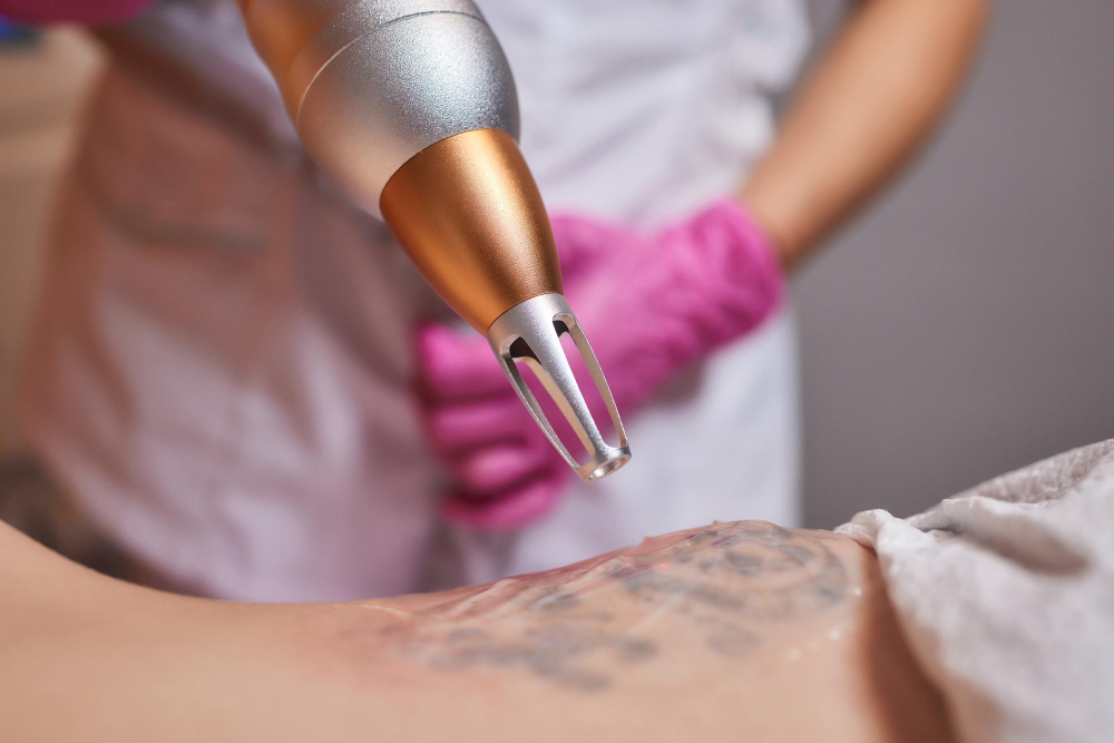 laser tattoo reoval